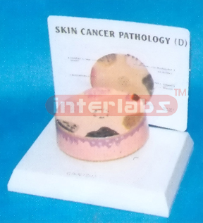 HUMAN SKIN CANCER MODEL WITH DESCRIPTION PLATE